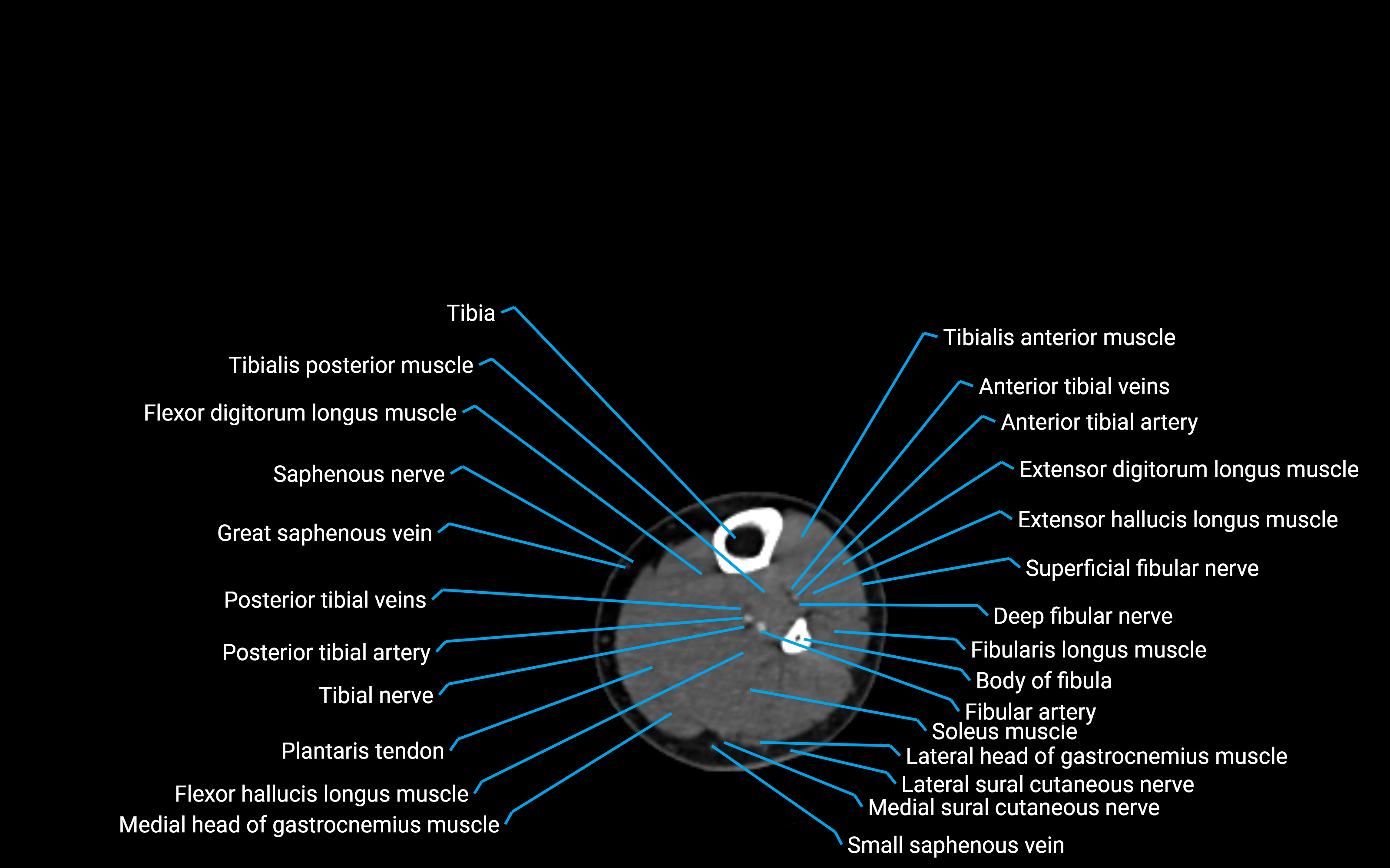 CT Lower leg axial cross sectional anatomy labelled image 116 (2).png